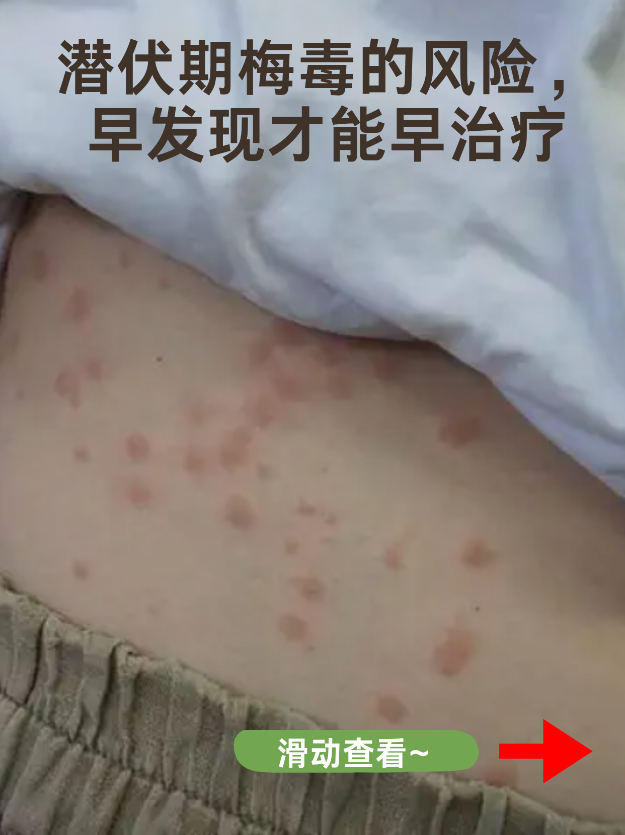 “德尔塔毒株或导致更严重疾病” 德尔塔毒株的临床症状？-第3张图片